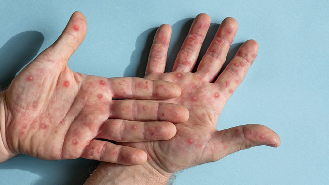 Sweden records its first case of deadly monkeypox strain