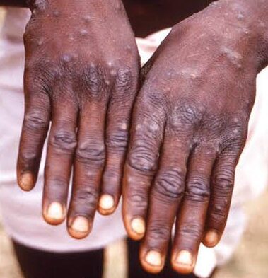 Abia state records first case of deadly Monkeypox