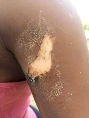 Tailor Allegedly Burns 17-Yr-Old Customer With Hot Iron In Osun